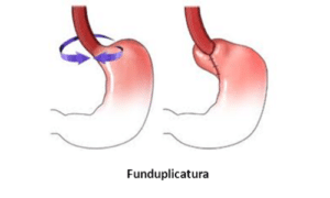 Funduplicatura