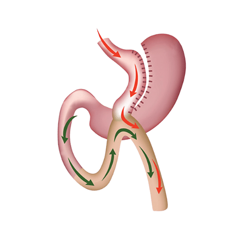 Minigastric bypass de una sola anastomosis en Obesidad Almería