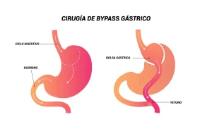 BYPASS GÁSTRICO OBESIDAD ALMERÍA