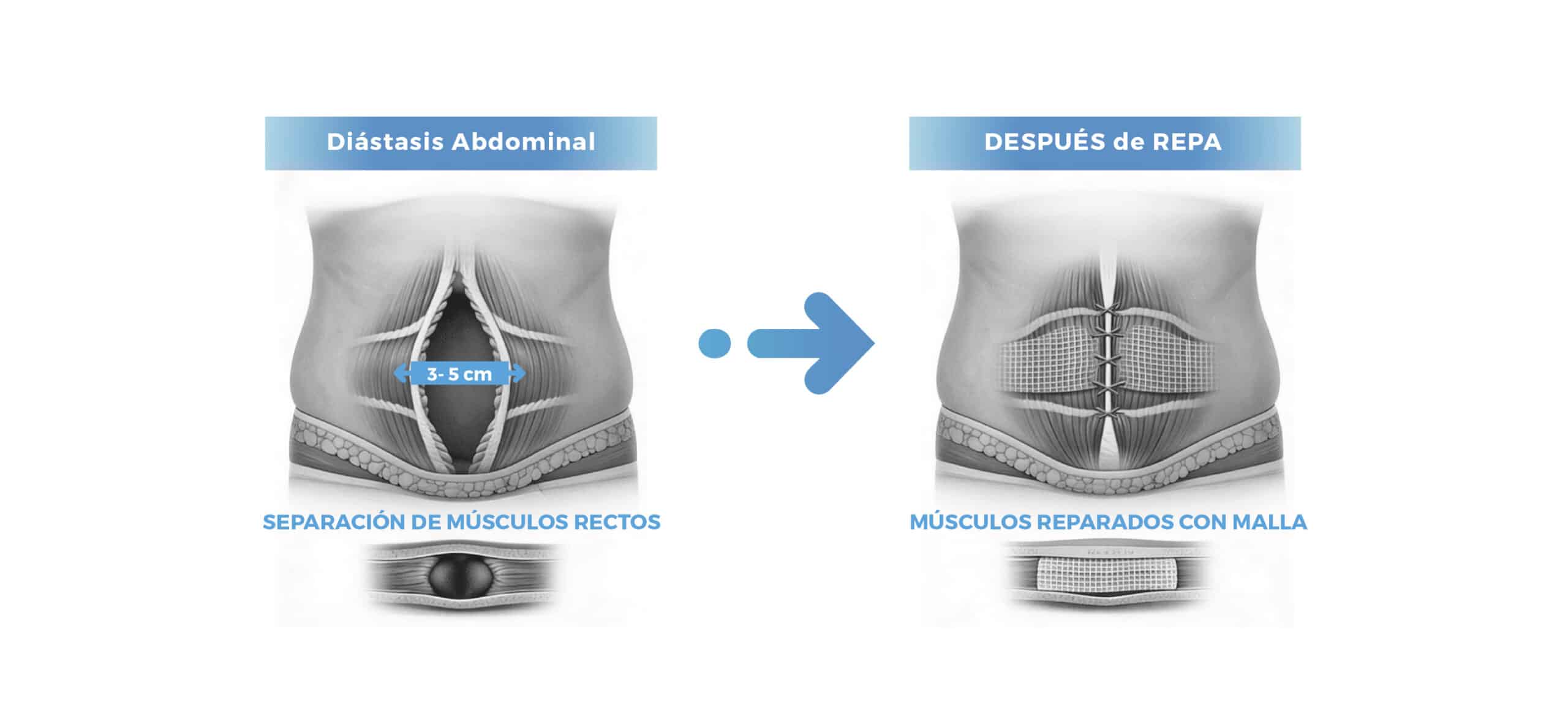 Diástasis abdominal antes y después de la Técnica REPA